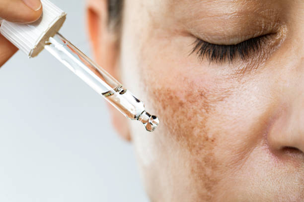 Pigmentation